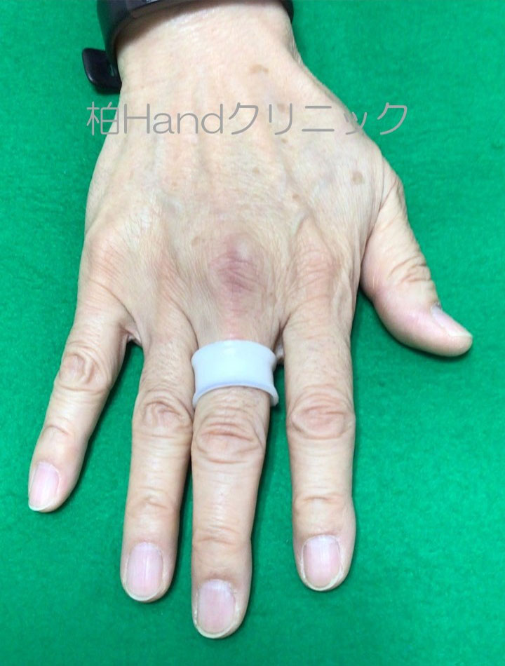 MP関節屈曲制限スプリント